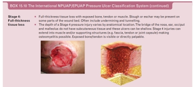 Stadium 4 Luka Tekan  - 