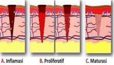 Tahap Penyembuhan Luka Tekan - 