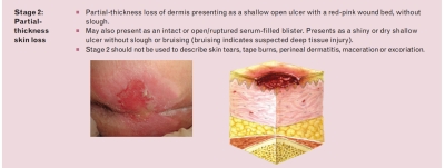 Stadium 2 Luka Tekan - 