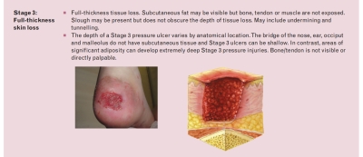 Stadium 3 Luka Tekan - 